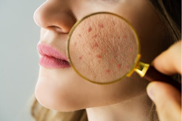 Better Results for Acne Scars